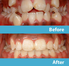 patient before and after esthetic reshaping