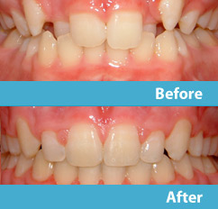 patient before and after esthetic reshaping