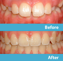 patient before and after esthetic reshaping