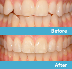patient before and after esthetic reshaping