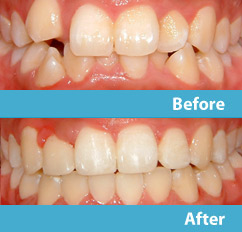 patient before and after esthetic reshaping