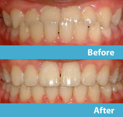 patient before and after esthetic reshaping